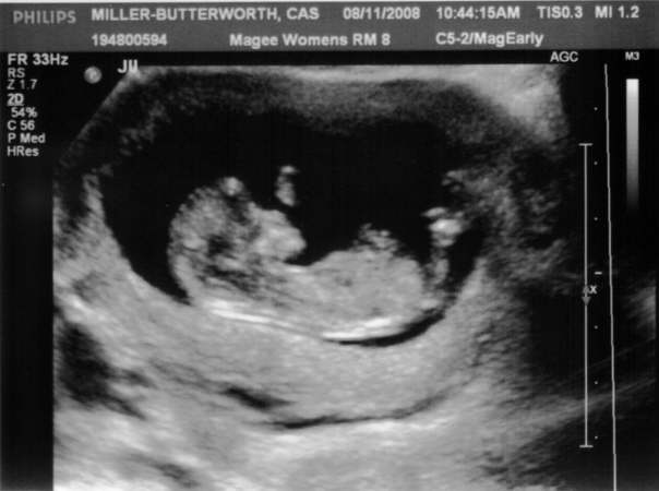 12 week ultrasound 3d