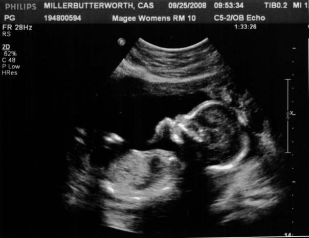 18 weeks ultrasound1