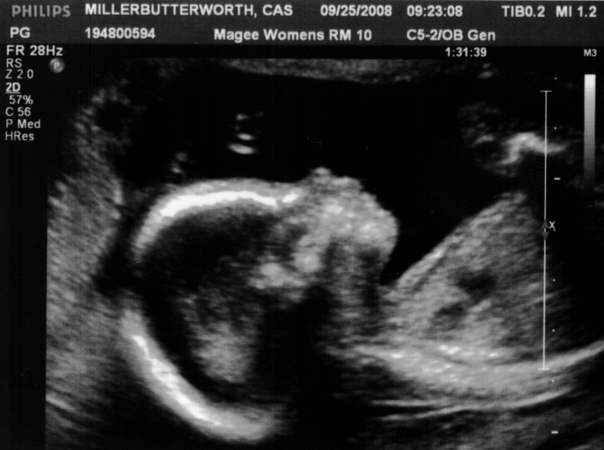 18 weeks ultrasound2