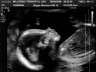 18 weeks ultrasound3