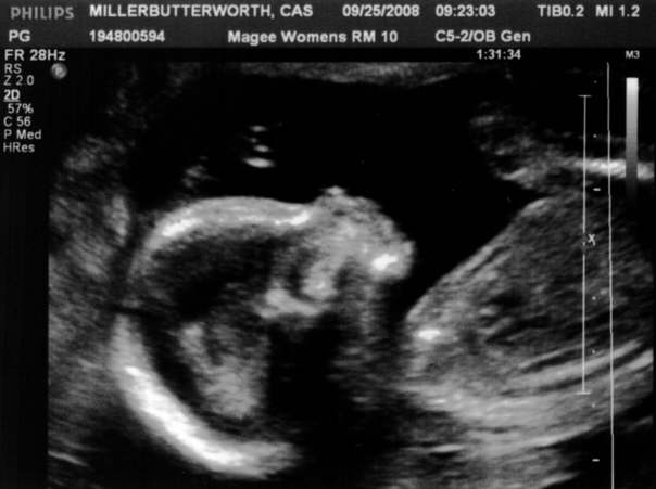18 weeks ultrasound3